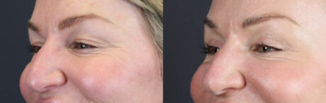 Blepharoplasty case #11097