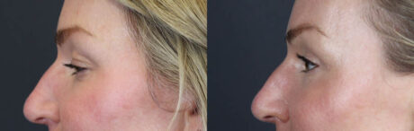 Blepharoplasty case #11097