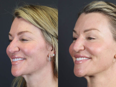 C02 Laser case #11016