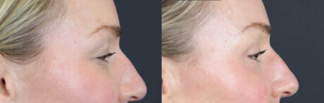 Blepharoplasty case #11097