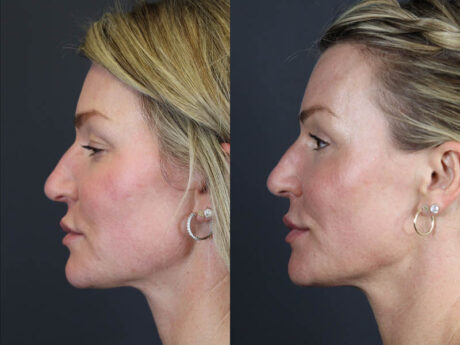 C02 Laser case #11016