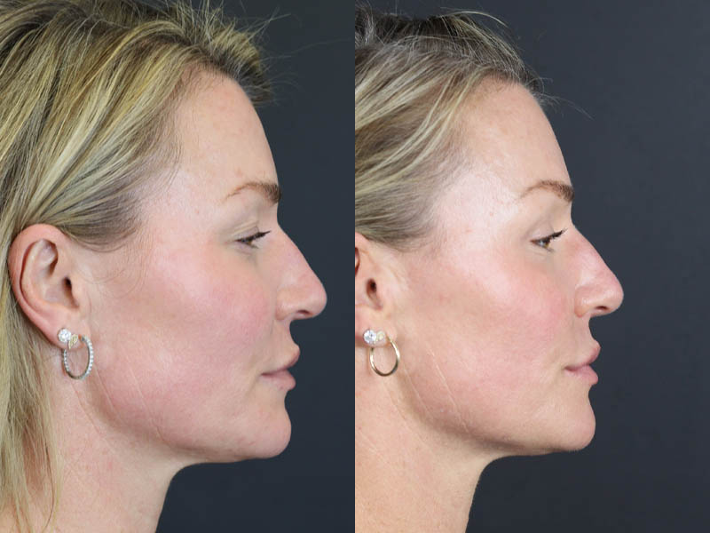 C02 Laser case #11016