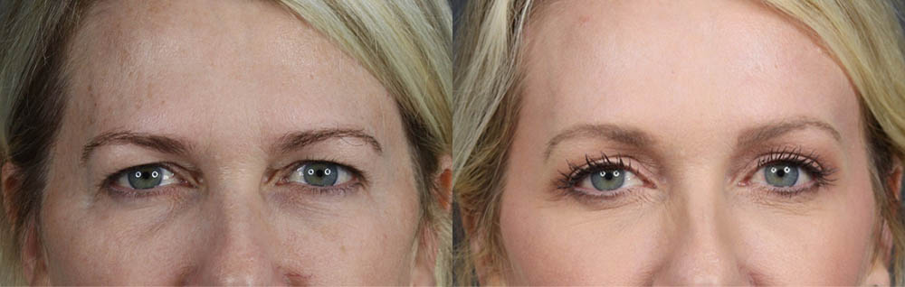Blepharoplasty case #11104