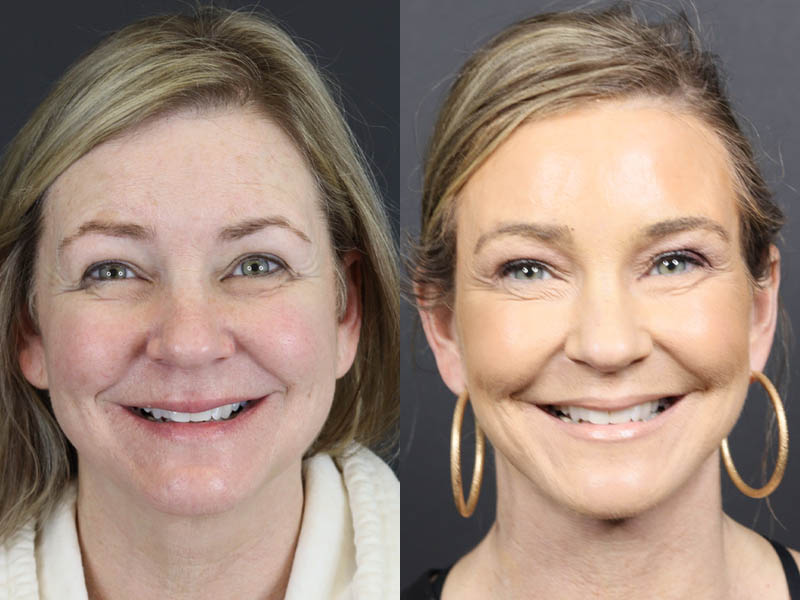 C02 Laser case #11033