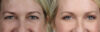 Blepharoplasty case #11104 slider thumbnail