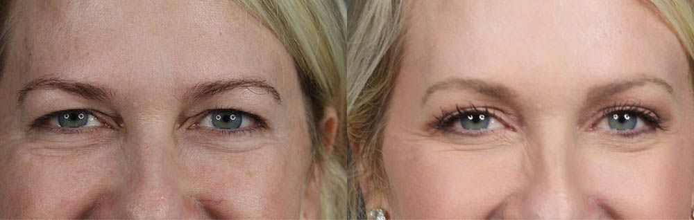 Blepharoplasty case #11104