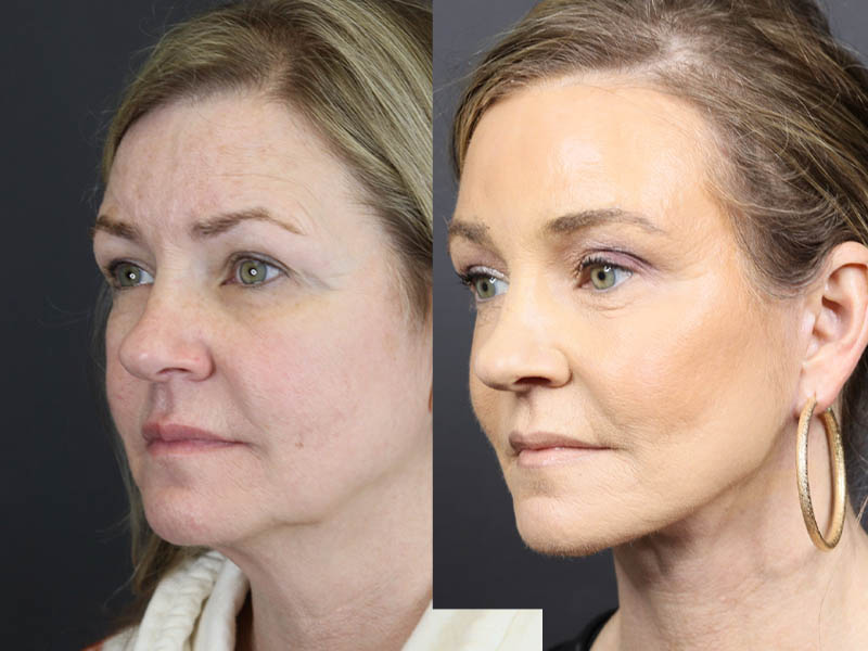 C02 Laser case #11033