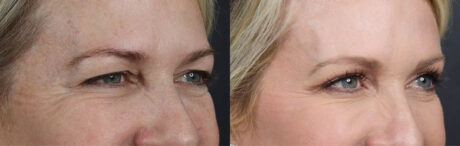 Blepharoplasty case #11104