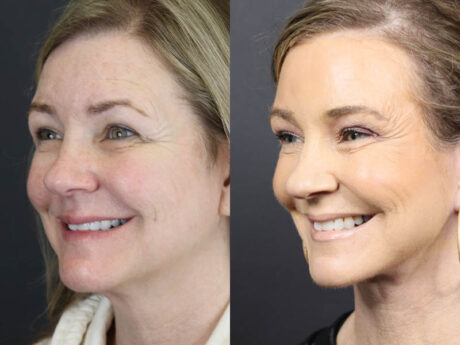 C02 Laser case #11033