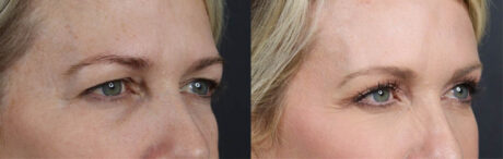 Blepharoplasty case #11104