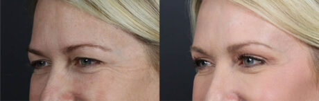 Blepharoplasty case #11104