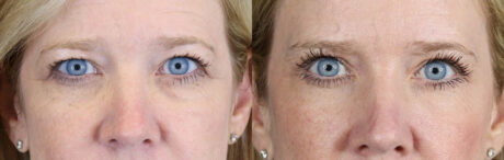Blepharoplasty case #11110