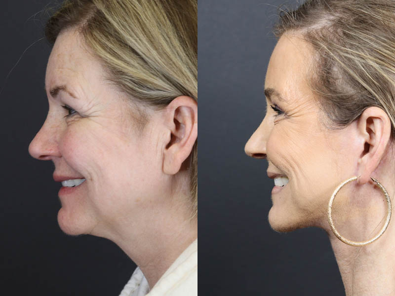 C02 Laser case #11033