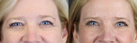 Blepharoplasty case #11110