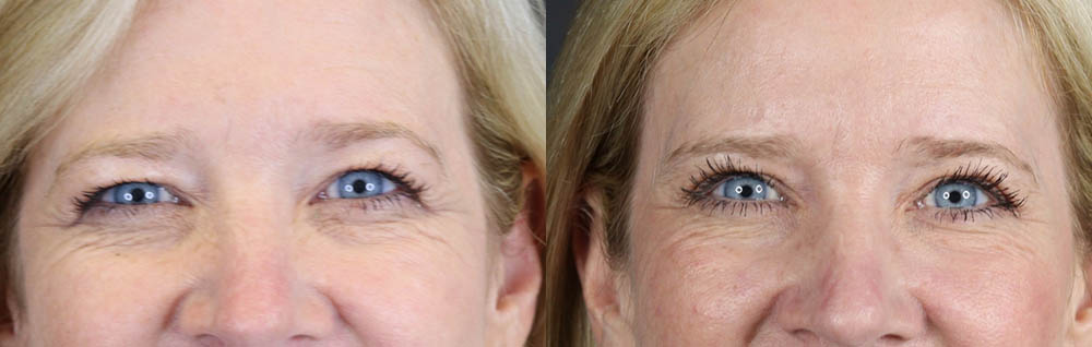 Blepharoplasty case #11110