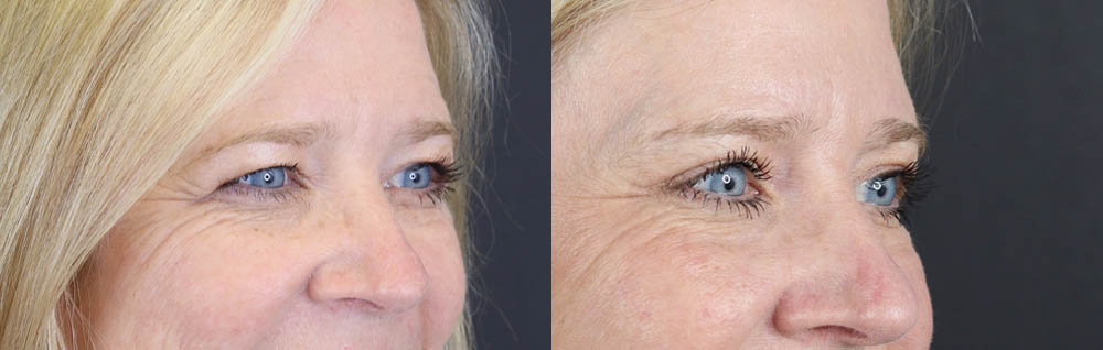 Blepharoplasty case #11110