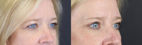 Blepharoplasty case #11110