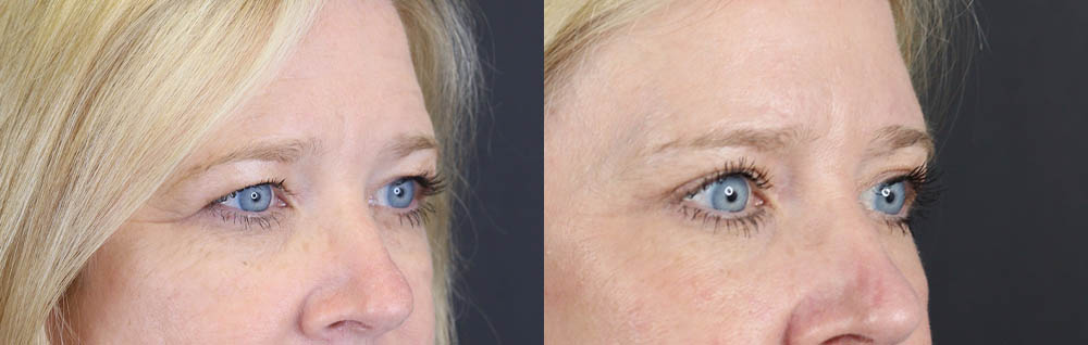 Blepharoplasty case #11110
