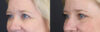 Blepharoplasty case #11110 slider thumbnail