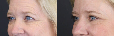 Blepharoplasty case #11110