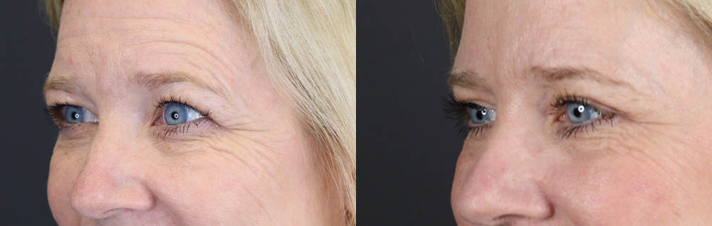 Blepharoplasty case #11110