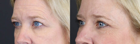 Blepharoplasty case #11110