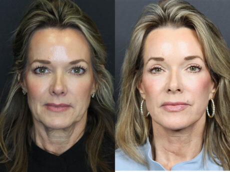 C02 Laser case #11048