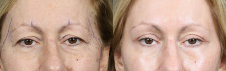 Blepharoplasty case #11117