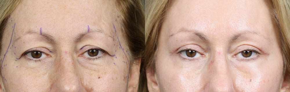 Blepharoplasty case #11117