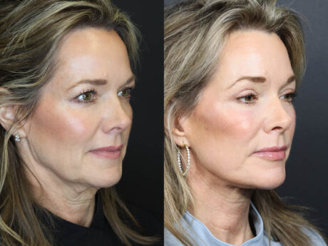 C02 Laser case #11048