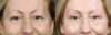 Blepharoplasty case #11117 slider thumbnail