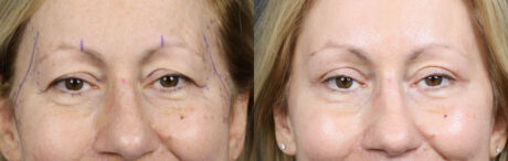 Blepharoplasty case #11117