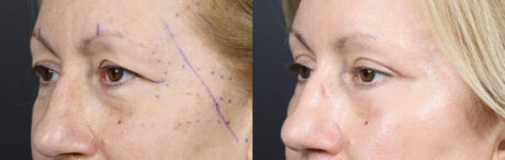 Blepharoplasty case #11117