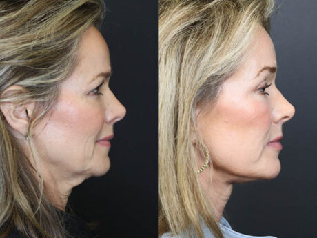 C02 Laser case #11048