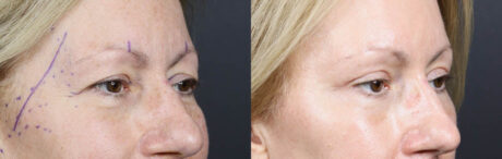 Blepharoplasty case #11117