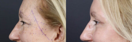 Blepharoplasty case #11117