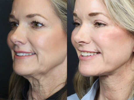 C02 Laser case #11048