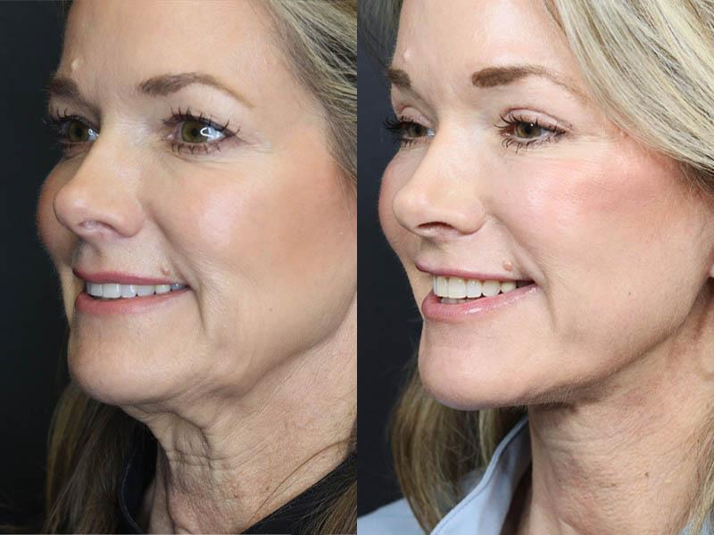 C02 Laser case #11048