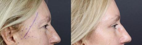 Blepharoplasty case #11117