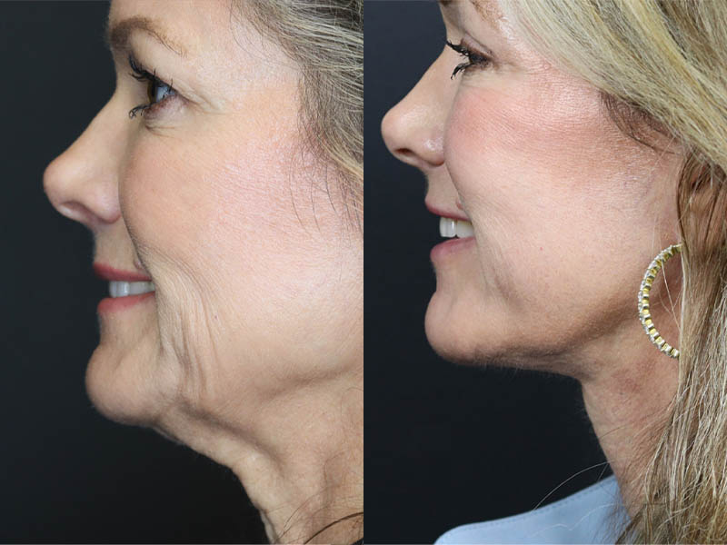 C02 Laser case #11048