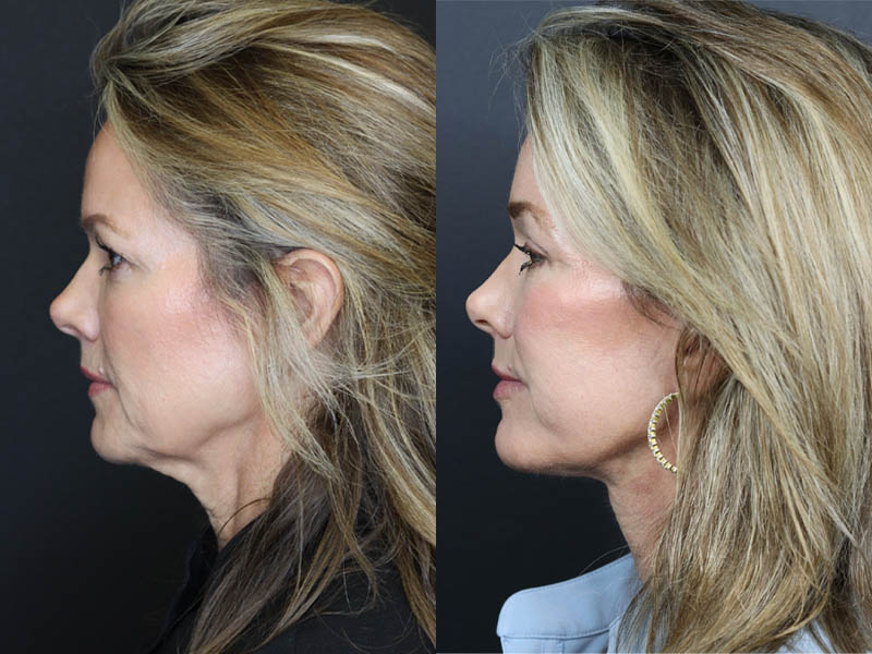 C02 Laser case #11048