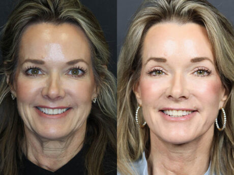 C02 Laser case #11048