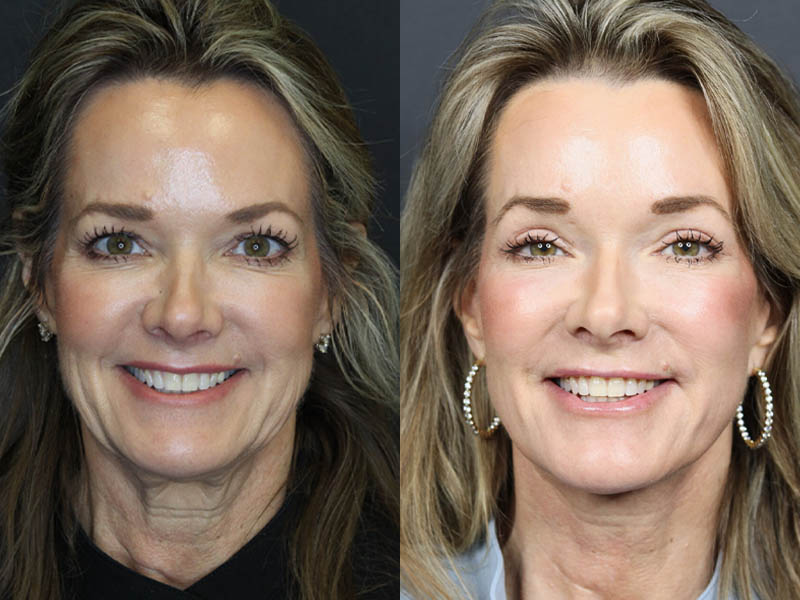 C02 Laser case #11048