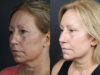 Deep Chemical Peel case #11008 slider thumbnail
