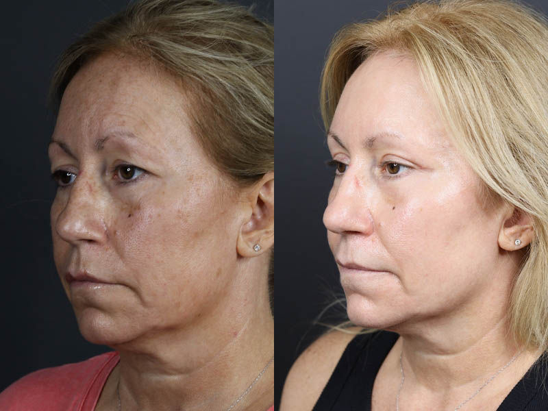 Deep Chemical Peel case #11008