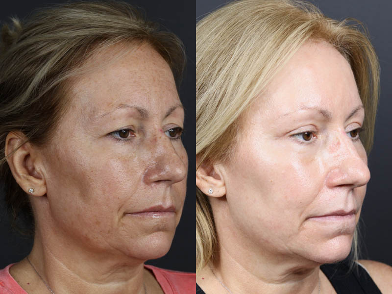 Deep Chemical Peel case #11008