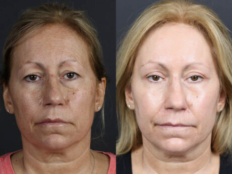 Deep Chemical Peel case #11008