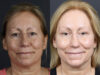 Deep Chemical Peel case #11008 slider thumbnail