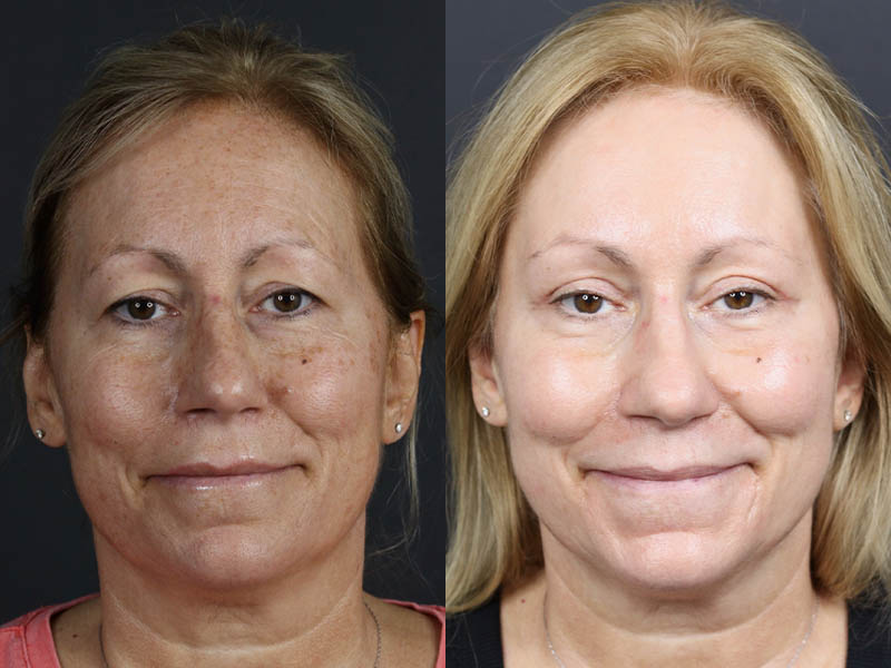 Deep Chemical Peel case #11008
