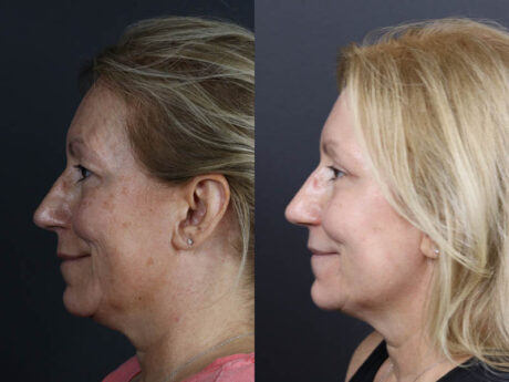 Deep Chemical Peel case #11008